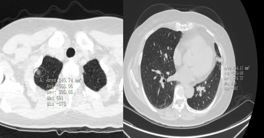 查CT查出肺结节，将来会发展成肺癌吗？