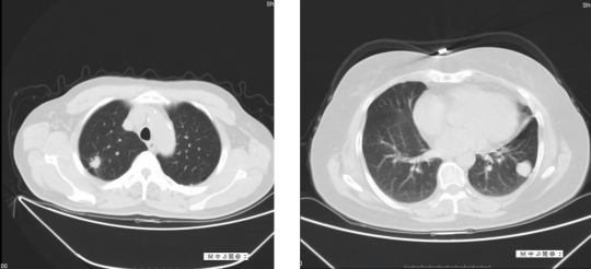 查CT查出肺结节，将来会发展成肺癌吗？