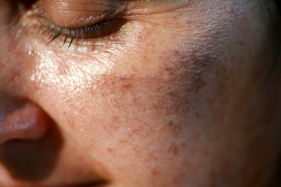 皮肤屏障受损导致的皮肤问题如何修复