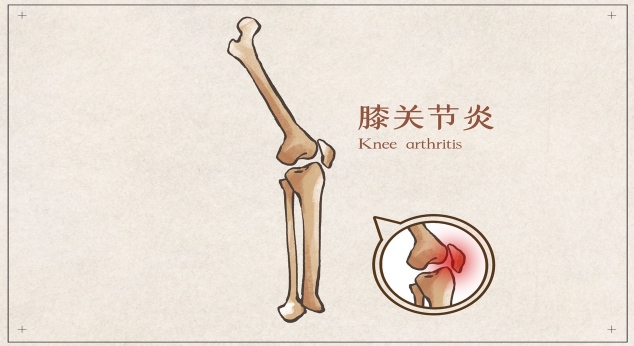 步入中老年的你，小心膝关节骨性关节炎！